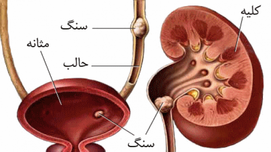 علت تشکیل سنگ کلیه