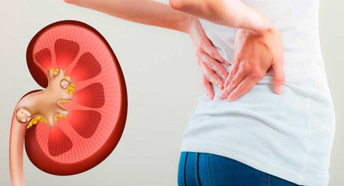 جراحی سنگ کلیه به روش ریرس