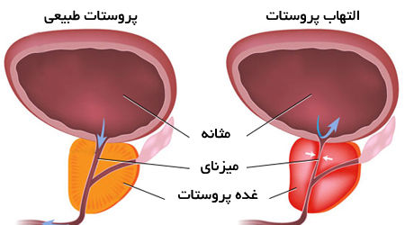 علائم پروستاتیت