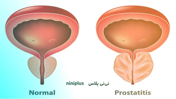 پروستاتیت باکتریایی مزمن