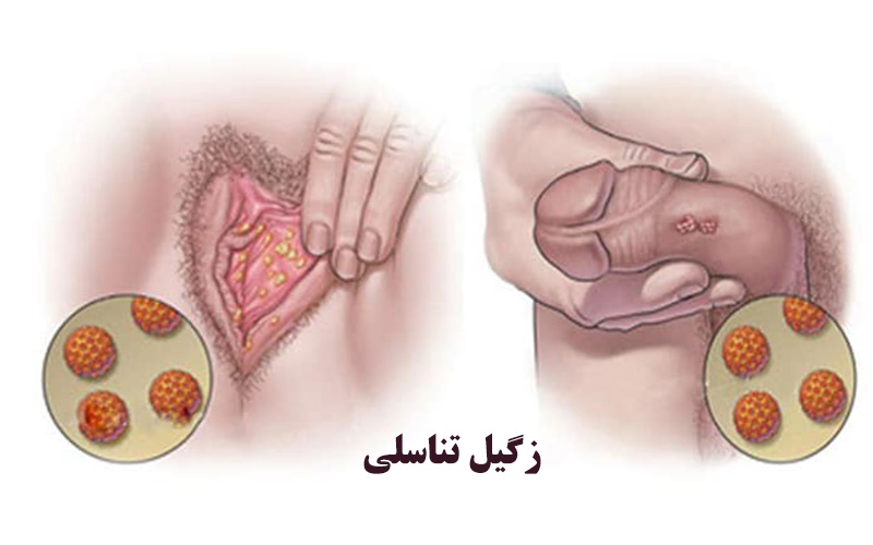 موثرترین روش درمان زگیل تناسلی