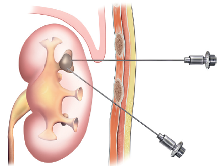 جراحی سنگ کلیه به روش PCNL