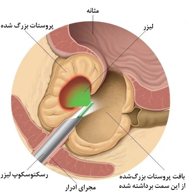 شایع ترین بیماری های پروستات