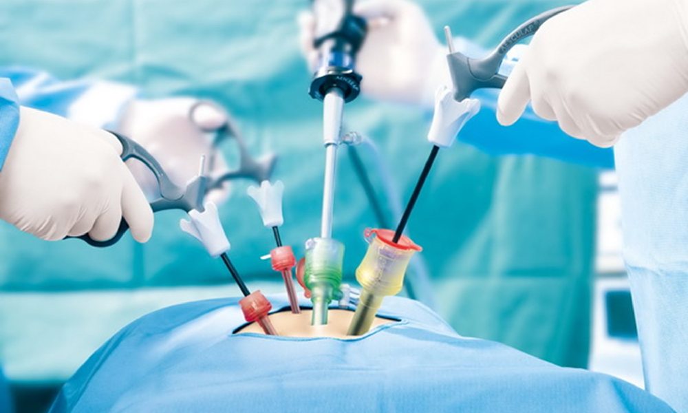 هیسترکتومی به روش لاپاراسکوپی