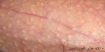 لکه های فوردایس