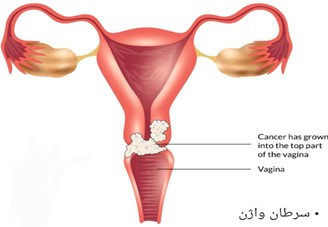 واژن