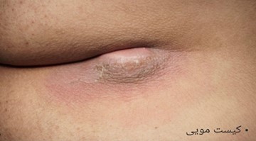 کیست پیلونیدال یا مویی