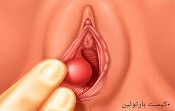 1. کیست بارتولین