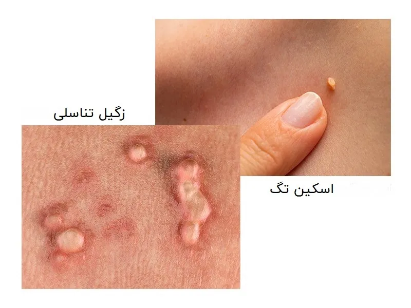 شباهت ها و تفاوت های ظاهری گوشت اضافه و زگیل تناسلی به چه صورت است؟