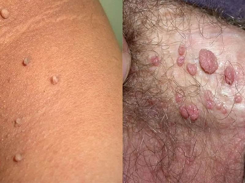 تفاوت زگیل تناسلی و گوشت اضافه