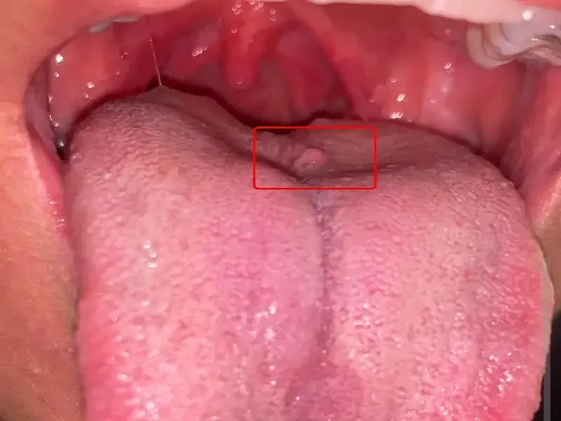 زگیل تناسلی در دهان و گلو: