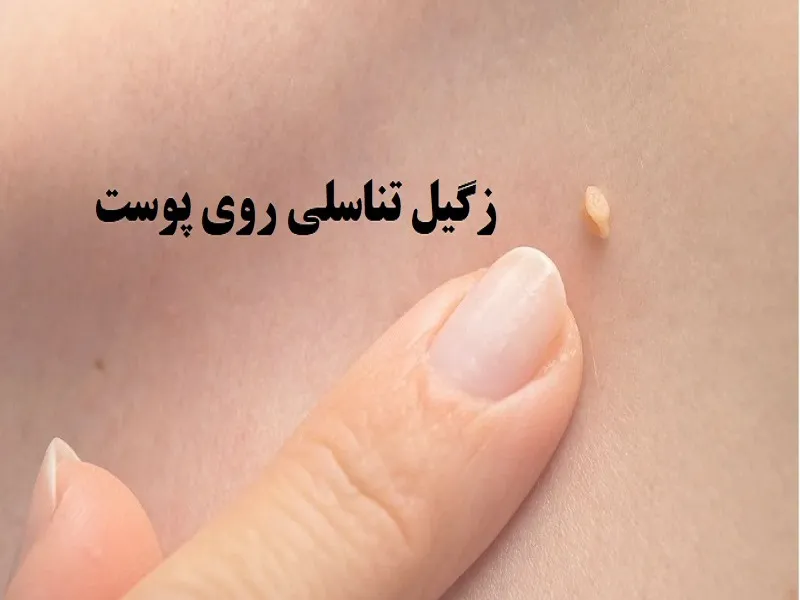 روش های درمان زگیل تناسلی چیست و مدت زمان مورد نیاز هر روش چگونه است؟