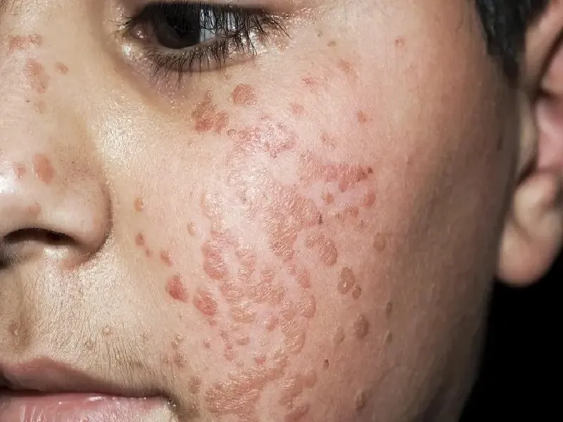 انواع مختلف زگیل بر روی صورت چگونه است؟