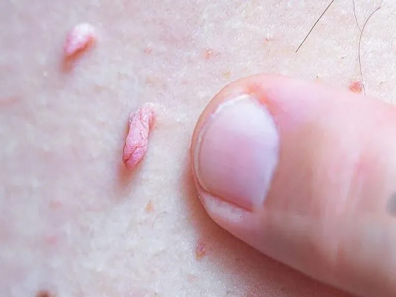 زگیل تناسلی پنهان چیست؟